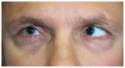 Figure 2 A patient with a right medial orbital wall fracture and medial rectus entrapment demonstrates restriction of abduction of the right eye.