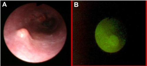 Figure 17 Polyps of esophagus, in white light endoscopy (A) and autofluorescence (B) imaging.