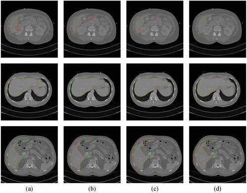 Figure 5. Typical liver segmentation results on CT images of the 3Dircadb1 (top row), the Sliver07 (middle row), and the CHAOS19 (bottom row) datasets by using four methods. (a) 2D U-Net. (b) 2D Auto-Net. (c) 2D UNet++. (d) the proposed method. Green contours indicate the ground truth segmentation, and red contours indicate the automatic segmentation by the algorithm.