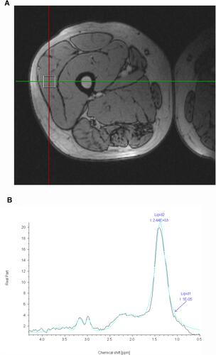 Figure 1 (A) 1H-MRS voxel placement from the vastus lateralis muscle of a patient with severe OSA. (B) The peak originating from the methylene protons of IMCLs of a patient with severe OSA by an 1H-MRS spectrum.