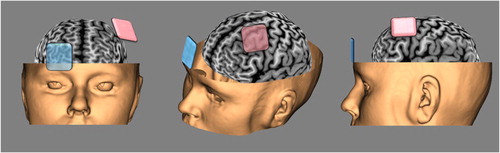 Fig. 1 Typical tDCS montage for cognitive/emotional research, that is, for the treatment of Major Depressive Disorder (anode in pink over the left DLPFC, cathode in blue over the right orbitofrontal cortex).