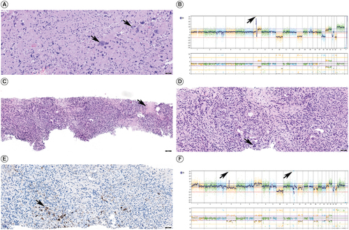 Figure 2. Patient's residual/recurrent glioblastoma patholog. (A) Histologic section of the residual/recurrent glioblastoma with giant cell features (black arrows), Hematoxylin and Eosin, scale bar 50 microns. (B) Whole genome copy number profile of residual/recurrent glioblastoma showing gains of chromosomes 7, 19 and 20, losses of chromosomes 10, 13, 18, 21 and 22 and amplification of EGFR on chromosome 7 (black arrow). (C) Histologic section of the lung mass demonstrating predominantly spindle cell neoplasm with areas of necrosis (black arrow) morphologically consistent with residual/recurrent glioblastoma with sarcomatous features. Hematoxylin and Eosin, scale bar 100 microns. (D) Histologic section of the lung mass demonstrating predominantly spindle cell neoplasm consistent with residual/recurrent glioblastoma with sarcomatous features, scattered multinucleated giant cells (black arrow) are present similar to the patient's intracranial tumor. Hematoxylin and Eosin, scale bar 50 microns. (E) Immunohistochemical stain for GFAP performed on lung mass showed scattered positive cells (black arrow), confirming the glial nature of the neoplasm. Scale bar 50 microns. (F) Whole genome copy number profile of lung mass showing gains of chromosomes 1p, 7 and 20, losses of chromosomes 4, 10, 13, 16, 18, 21 and 22 and amplifications of PDGFRA and CDK4 on chromosomes 4 and 12, respectively (black arrows).