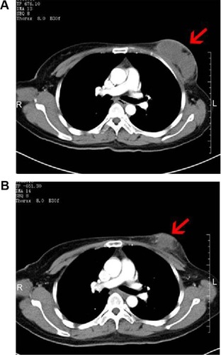 Figure 4 CT images of a 46-year-old patient with breast cancer.