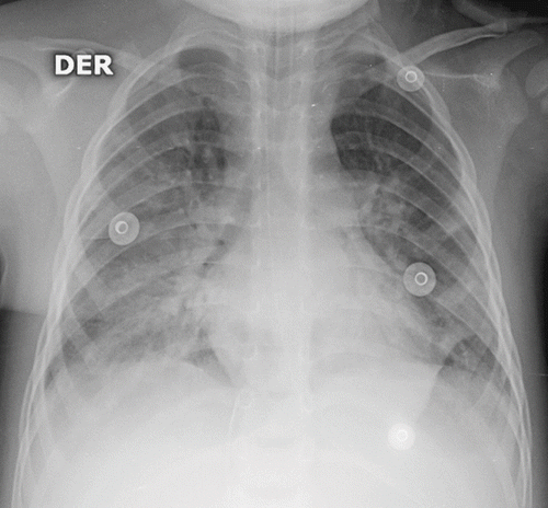 Fig. 1. Chest radiograph on third day. Diffuse alveolar infiltrates compatible with acute respiratory distress syndrome.