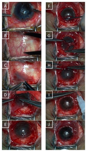 Figure 1 Corneal epithelium debridement (A) is followed by pre-measurement of the size of the conjunctival autograft required (B). After bulbar conjunctival dissection (C), a 270-degree limbal peritomy with two 45-degree relaxing incisions at 5 and 7 o’clock was performed with limbal diathermy. The flaps were mobilized over the corneal surface (D) and inferior conjunctiva was dissected (E) to ensure better corneal coverage if needed (this was especially so in eyes with scarred superior conjunctiva secondary to glaucoma drainage devices). Fibrin glue was then applied to the underside of the graft (F) and the flap was positioned epithelium-side up (G). The flap edges are later opposed (H) and subconjunctival injections of steroids and antibiotics are given at the end of the procedure (I). The final result is as shown in (J).