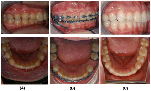 Figure 7 Patient above, in A, was given a removable appliance to advance lower anterior teeth in a Class II case. Spaces were created between lower bicuspid teeth as a consequence of this movement, as shown in B. Temporary anchorage devices were placed bilaterally to allow for all posterior teeth to be brought forward to close the space that had been created. Effectively, the entire lower dentition was advanced over the time in treatment. The airway improved in his case as shown below (Figure 8).