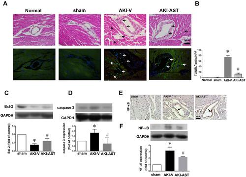 Figure 7 AST-120 therapy reduced cell apoptosis and NF-κB activation following renal I/R injury. (A and B) Detection of apoptosis (arrows) by HE staining (upper panels) and TUNEL staining (lower panels) in the normal (both kidneys intact), sham, AKI+V, and AKI+AST groups. The number of apoptotic cells per high-power field was counted. n = 4 per group; the data are presented as mean ± SEM, *p < 0.05 vs the sham group; #p < 0.05 vs the AKI+V group. (C and D) The expression of Bcl-2 and caspase 3 at day 2 after I/R injury in heart tissues from the sham, AKI-V, and AKI-AST groups determined by Western blotting. n = 6 per group; the data are presented as mean ± SEM, *p < 0.05 vs the sham group, #p < 0.05 vs the AKI+V group. (E and F) NF-κB expression in the three groups was screened using an immunohistochemistry assay. Representative photomicrographs of immunohistochemical staining for NF-κB in heart tissues from the sham, AKI-V, and AKI-AST groups. n = 4; the data are presented as mean ± SEM, *p < 0.05 vs the sham group; #p < 0.05 vs the AKI-V group.