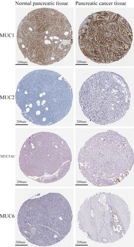 Figure 7 The protein expression of MUC1, MUC2, MUC5AC and MUC6 in normal pancreatic tissues and PDAC tissues from the Human Protein Atlas (HPA, https://www.proteinatlas.org/).