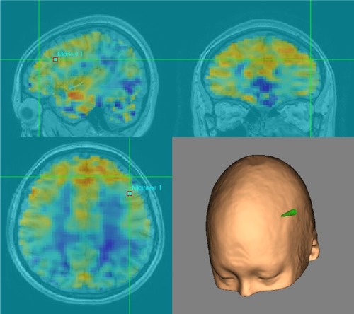 Figure 1 The left dorsolateral prefrontal cortex (−44,40,29) was targeted using a MRI-guided neuronavigation system, and the location of the TMS coil was marked on a cap.