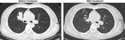 Figure 3 Computed tomography scan showing that the lung tumor shrank significantly after erlotinib treatment.