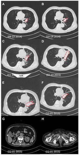 Figure 2 CT images reflect the dynamic changes of the patient’s responses to the treatment plans. (A) Size of lung SQCC (1.7x1.7 cm, red dotted line) soon after the initial diagnosis by fiberoptic bronchoscopy; (B) Radiation pneumonitis and unchanged tumor size (1.7x1.7 cm, red dotted line) after radiotherapy; C) Radiation pneumonitis and increased tumor size (2.1x2.8 cm, red dotted line) after radiotherapy; (D) Increased tumor size (3.1x9.4 cm, red dotted line) after platinum-based chemotherapy; (E) Reduced tumor size (3.5x6.3 cm, red dotted line) 4 months after targeted therapy; (F) Further reduced tumor size (2.47x2.47 cm, red dotted line) 9 months after targeted therapy; (G and H) Follow-up images of CCRC and prostate adenocarcinoma in 2015 showed no sign of tumor recurrence.