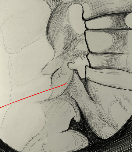 Figure 3 Lateral view showing the cannula (red) placed across the middle two-quarters of the neck of the superior articular process.