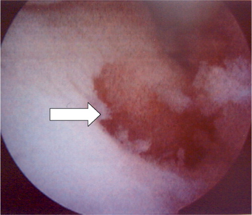 Figure 4. Case 1. Intraoperative view following resection of the osteoid osteoma in the talus. The remaining crater is indicated by an arrow.