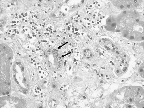 FIGURE 1. Interstitial infiltration from chronic inflammatory cells and mild tubulitis elements (arrows). (Hematoxylin and Eosin stain, original magnification ×250.)