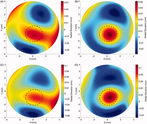 Figure 1. Case example of elevation maps in a progressive keratoconus case. (A) Front surface: baseline radial elevation map. Dotted line: estimated cone region. (B) Front surface: post-progression (in 25 months) radial elevation map. Dotted line: estimated cone region. (C) Back surface: baseline radial elevation map. Dotted line: estimated cone region. (D) Back surface: post-progression (in 25 months) radial elevation map. Dotted line: estimated cone region.