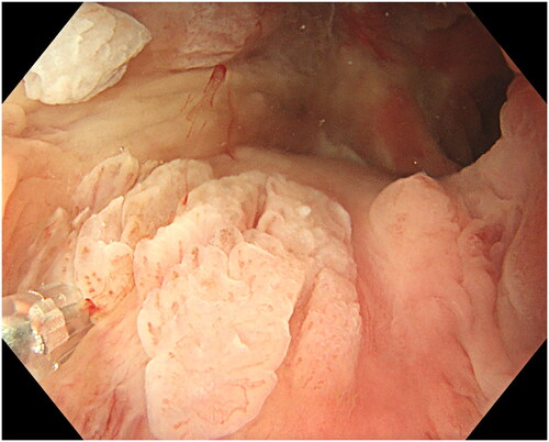 Figure 2. Creating a submucosal cushion under the lesion and also providing local anesthesia. Proximal and on the left side of the lesion is the mucosa paler after the previous injection. At 11 o’clock is an exophytic whitish non-villous exophytic ASIL.