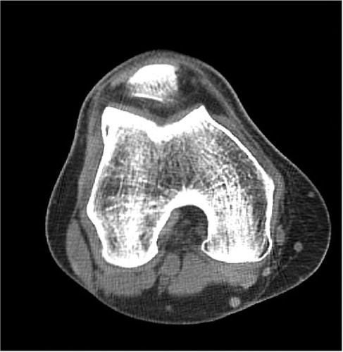 Figure 6. Postoperative axial CT scan with an improvement of the trochlear depth, measured at the same level and in the same patient as in Figure 5.