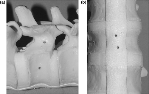 Figure 1. Small titanium markers, 1.6 mm in diameter and 8 mm in length, were placed in the lateral pedicle, lateral vertebra and anterior vertebra for the point accuracy test.