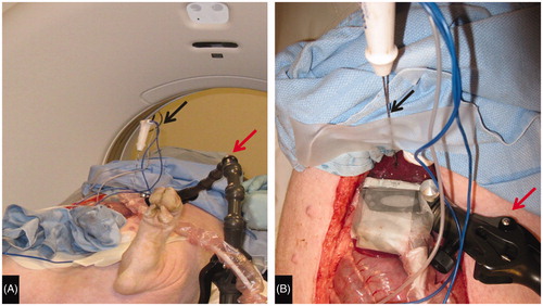 Figure 1. Experimental setup. (A) Swine on CT Table with articulating arm (red arrow) to which ultrasound transducer is affixed extending from table and RF antenna (black arrow) secured in place. (B) View of liver surface with ultrasound transducer (green arrow) affixed to the articulating arm (red arrow) perpendicular to the plane of the RF antenna (black arrow).