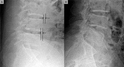 Figure 1 Translational instability in the sagittal flexion (A) and extension (B) views on plain radiography. Black lines and arrows indicate the distances as a result of migration of adjacent upper vertebra upon lower lumbar vertebrae during flexion.