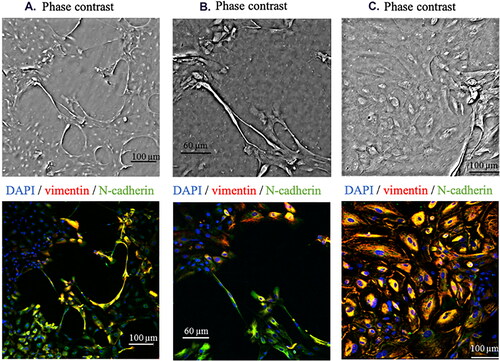 Figure 1. Spontaneous differentiation in vitro of LECs from anterior lens capsule isolated from T2D cataract (A) and (B). LECs from anterior lens capsule isolated from age-related cataract (C).