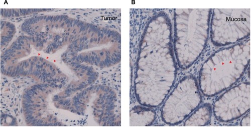 Figure 3 Representative immunohistochemistry revealing spatial localization of Smurf2 protein (40 × magnification).Notes: Smurf2 was strongly expressed in the tumor cells (A), particularly in the cytoplasm (arrowheads), whereas healthy mucosa cells (B) only showed a very weak expression of Smurf 2.
