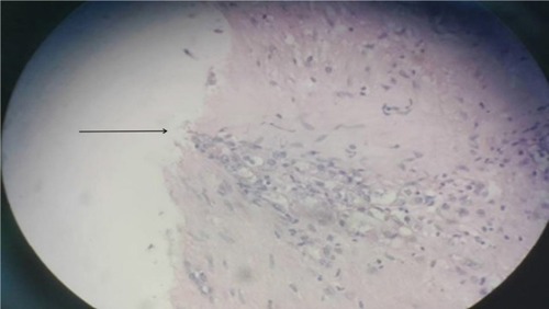 Figure 2 A small amount of tumor cells at the margin of incision.