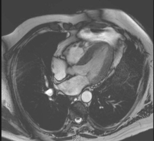 Figure 3. Cardiac MRI showing no evidence of delayed myocardial enhancement to suggest myocarditis, infarct or infiltrative disorder.