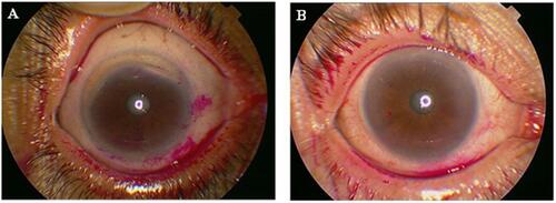 Figure 2 Ocular staining score (OSS). (A) OSS with rose bengal dye giving a score >3. (B) OSS with rose bengal dye giving a score <3.