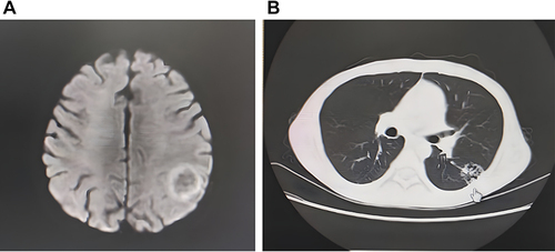 Figure 1 (A) Contrast enhanced Magnetic resonance imaging showed the left parietal lobe mass with ring enhancement; (B) computed tomography scan shows hollow shadows in left lung field.