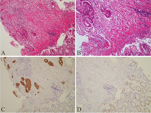 Figure 3 (A) Low power and (B) higher power image of hematoxylin and eosin stains showed the atypical glands in the mucosal muscularis of the sigmoid colon. (C and D) Immunohistochemical stains of the adenocarcinoma of the sigmoid colon showed strong positivity in CK7 (C) and negative in CK20 (D).