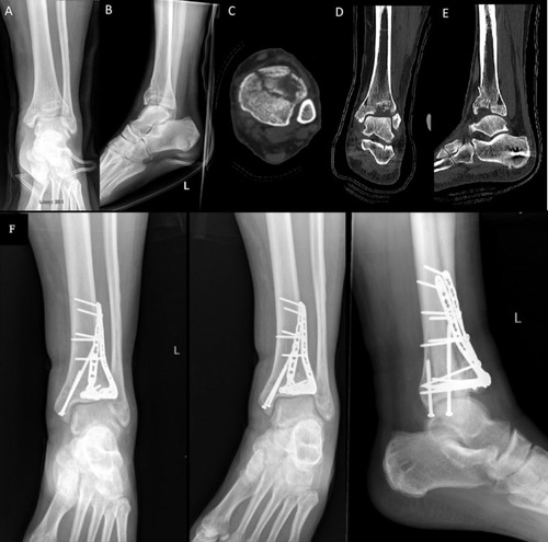 Figure 1 Fracture seen on plain radiographs (A, B), details of the injury further enhanced via CT (C–E). The CT axial cut (C) showing classic formation of the three main fracture fragments, Tillaux-Chaput, medial malleolus, and Volkmann. Appreciation of the depression on CT can aid the surgeon in preparation of the metaphyseal defect encountered after restoration of the articular surface. Final follow-up radiographs (F) demonstrating restoration of the articular surface and good anatomical alignment following open reduction and internal fixation.