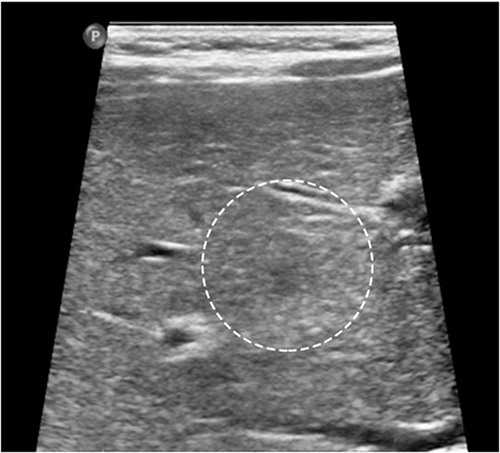 Figure 7 After 4 months of treatment, the solid mass in the right liver shrank to approximately 0.9×0.9 cm. The white circle indicates the location of the hepatic hemangioma.