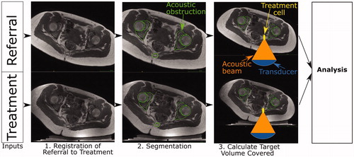 Figure 2. Schematic of developmental methodology used in this study. The accuracy of the methodology to calculate target coverage from referral imaging was assessed using this workflow. The target volume coverage by MRgHIFU was calculated from a subject’s treatment image dataset, acquired with the subject placed in a plausible or actual treatment position (bottom row) for volunteers or patients, respectively. Comparison with the target volume coverage predicted from a supine referral image datasetet allowed assessment of the methodology. Step 1: the referral imaging dataset is rotated into the same orientation as the treatment imaging dataset using affine registration both to allow comparison with the treatment imaging dataset. Step 2: segmentation of acoustic obstructions (e.g. bones, shown), organs at risk (patients only) and the target tumors (patients only) was performed to identify tissues that impede target coverage. Step 3: Target volume coverage was calculated for the registered-referral imaging dataset and the treatment imaging dataset, and finally, the two quantities were compared to assess the predictive capacity of the methodology.