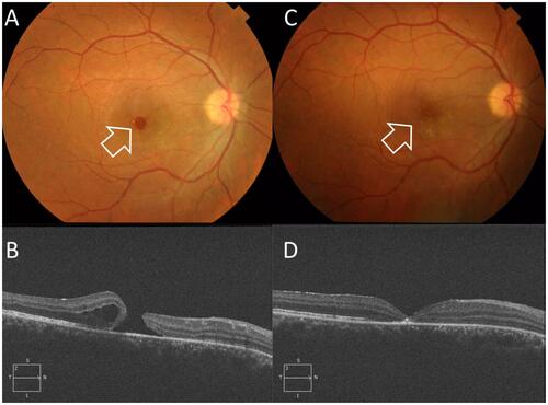 Figure 4 Case # 10. (A) Color photo of the left eye of a 24-year-old male patient. The patient sustained blunt trauma to the left eye by an air hose since 4 months. His BCVA was 0.01 decimal. The posterior pole showed a FTMH < 1/3 DD (white arrow). (B) High-definition 5-line raster OCT image of the same eye showed FTMH with MLD 509µ. Note the cystic thickening at the edges of the hole. (C) Color photo of the same eye 8 months after PPV and modified IFT, showed successful hole closure (white arrow). His final BCVA was 0.2 decimal. (D) High-definition 5-line raster OCT image post-operatively showed V-type closure.