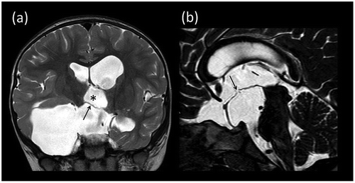 Figure 2. Post-operative MRI. (a) Coronal T2-weighted image showing partial decompression of the arachnoid cyst. Note that the third ventricle (asterisk) has now partially re-expanded with descent of the previously elevated third ventricular floor (arrow). (b) Midline sagittal constructive interference in the steady-state (CISS) image showing the fenestration in the floor of the third ventricle with small CSF flow voids indicating patency.