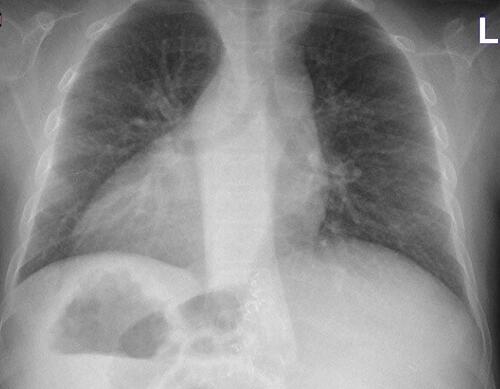 Figure 1 Preoperative chest radiograph showing dextrocardia and chronic pulmonary changes.