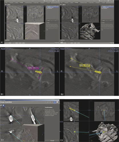 Figure 2. Top: Preoperative threshold adjustment to bony structures (A1, A2). Center: Preoperative assessment of the glenoid version (B1) and planning of the guide wire trajectory on the navigated image data set (B2): preoperative glenoid version is 5° (pink), thus, the angle for eccentric reaming to achieve glenoid version of −10° is defined as 15° (yellow). Bottom: System verification (C1) and real-time guidance of the navigated drill sleeve along the planned trajectory (C2).
