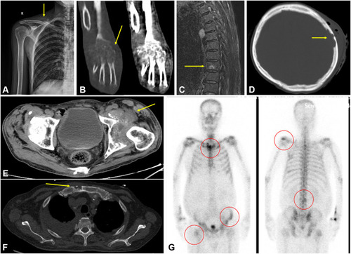 Figure 1 X-ray radiography revealed a pathological fracture in the right clavicle (arrow) (A from patient 5). CT of the right wrist and palm revealed moth-eaten and irregular destruction of the bone in the right metacarpal and adjacent joints, narrowing of the joint space and swelling in the surrounding soft tissues (arrow) (B from patient 3). A sagittal magnetic resonance imaging (MRI) scan (fat-saturated T2-weighted image) revealed high signals within the L3 vertebral body (arrow) (C from patient 8). Computed tomography (CT) of the head and brain revealed irregular destruction of the bone in the inner plate of the left frontal bone with surrounding abscess formation (arrow) (D from patient 5). Pelvic CT revealed irregular destruction of the bone in the left acetabulum and femoral head, narrowing of the hip joint space, and surrounding abscess formation (arrow) (E from patient 3). Chest CT scan revealed an irregular bone defect in the manubrium of the sternum with a sclerotic edge (arrow) (F from patient 8). ECT bone scan revealed increased radioactive concentrations in the manubrium of the sternum, multiple ribs, L3 vertebral body, bilateral sacroiliac joints, left ilium, and upper end of the right femur (G from patient 8).