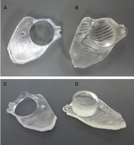 Figure 2. STAMP plates generated from the patient’s CT scan bony surface characteristic data: (A, C) BB-STAMP plate; (B, D) C-STAMP plate. Since this BB-STAMP plate (guide plate) fits only at one place, the big circle can be the guide hole leading to the correct place to make a bony hollow, while small circles indicate the appropriate places for screws. The C-STAMP plate (confirmation plate) can certify the correct size and place of the bed for the BC-FMT: (A, B) surface view; (C, D) back view). BB, Bonebridge; BC-FMT, bone conduction-floating mass transducer; C-STAMP, the C-STAMP can check whether the hole is an appropriate size for the BC-FMT.