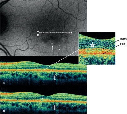 Figure 2 Case 4 fundus autofluorescence and high definition spectral domain optical coherence tomography (HD-OCT). Fundus autofluorescent frame of the left eye (20/25 best corrected visual acuity) shows mottled autofluorescence in the macular area and retinal flecks (thin arrows). HD-OCT scans (A and B) show disruption of either the layer between the retinal pigment epithelium (RPE) and the outer segment (OS) of the photoreceptors (PR) (enlarged view), either the layer corresponding to the interface of inner segment (IS) and OS of PR in the foveal region (enlarged view; asterisks), and a focal loss of the PR layer in the parafoveal region (open arrows).