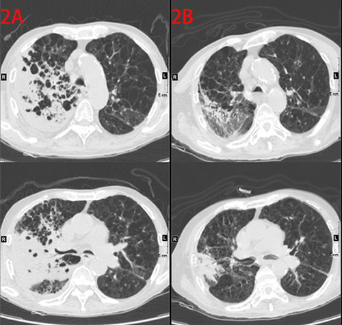 Figure 2 Chest X-ray. (A) Before treatment with carrimycin. (B) After 4 weeks of treatment with carrimycin.