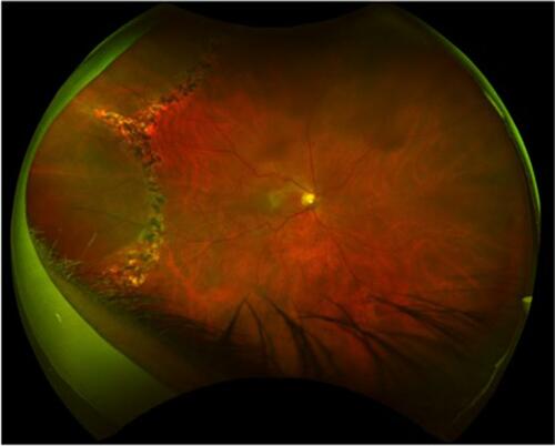 Figure 1 Case 1: 3-year follow-up of temporal rhegmatogenous retinal detachment treated with demarcation-laser photocoagulation.