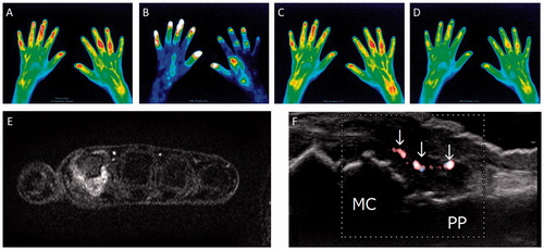 Figure 2. Representative images of FOI and corresponding images of MRI and CDUS. A composite image (A), representative images of Phase-1 (B), Phase-2 (C) and Phase-3 (D). The second MCP joint of the right hand showed grade 3 enhancement in Phase-1. The third and fourth PIP joints of the right hand and the fifth PIP joint of the left hand also showed enhancement in the composite image and all three phases. The second MCP joint of the right hand also showed enhancement in MRI (E) and positive CDUS in the thickened synovium (F, arrows). MC: metacarpal bone, PP: proximal phalanx.