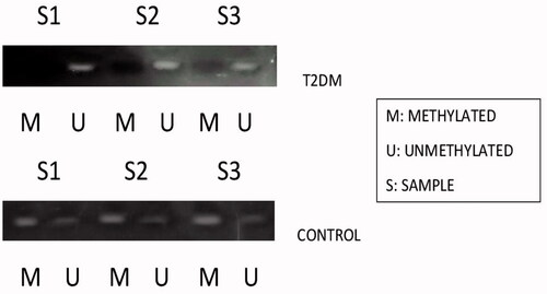 Figure 5. Represents the methylation status of miR-1285 promoter region in type 2 DM samples and the control samples by methylation sensitive PCR (MSP).