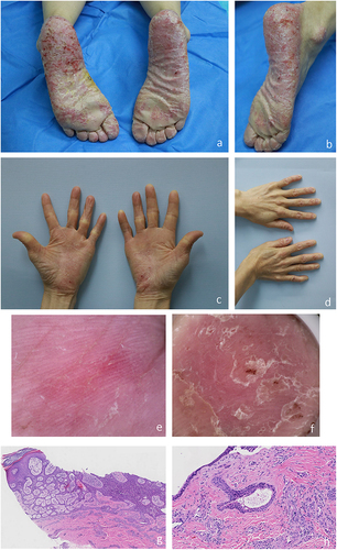 Figure 1 Clinical, dermoscopy and histological image taken at the patient’s initial visit. (a–d) The patient presented with large, symmetrical erythema accompanied by scaling on the palms, soles, and lateral margins of the skin. The patient’s feet appeared dry and chapped, and the Auspitz sign was negative. Some of the nails and toenails exhibited deformities and visible signs of damage. No similar skin lesions were found elsewhere on the body. (e) Dermoscopy of the patient’s hand revealed a reddish background of the hand skin with red areas and surrounding white scales. (f) Dermoscopy of the patient’s foot revealed a light red heterogeneous background. The erosions presented as milky red areas, characterized by a central black scab-like region, surrounded by concentric white circle-like layered scales. (g) Narrow epithelial cords connect to the skin, forming a grid-like structure (H and E × 50). (h) Locally, there was evident typical ductal differentiation (H and E × 200).