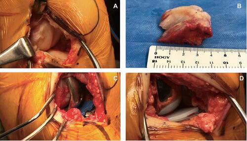 Figure 3 (A) Perioperative photographs documenting the extent of cartilage damage at the lateral aspect of the right knee. (B) Excised portion of the proximal tibia with dimensions approximately 40 × 30 × 20 mm. (C) Placement of the trial implant with the smallest available polyethylene spacer insert. (D) Final UKA implant with cement and polyethylene insert as shown.