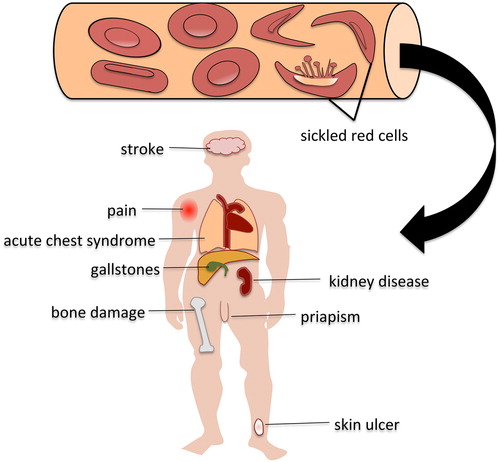 Figure 1. Complications of sickle cell