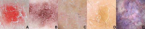 Figure 1 Dermoscopic images of background color: (A) bright red, (B) dull red, (C) light red, (D) yellowish, and (E) purplish (x10 original magnification).