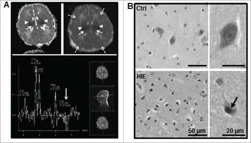 Figure 8. Lentiform nucleus of asphyxiated human term newborns is highly vulnerable. (A) Magnetic resonance (MR) diffusion-weighted images with ADC maps (top panel) of hypoxic-ischemic encephalopathy (HIE) case 1 (left) at 36 h of life and HIE case 7 (right) at 23 h of life showed bilateral restricted diffusion in the basal ganglia (mainly in the putamen, arrowheads) and thalamus (long arrows) as well as in the cortex of case 7 (dashed arrows). MR multivoxel proton spectroscopy of HIE case 7 showing a negative double lactate peak at 1.2 ppm indicating an acute energy failure in this region (white arrow) at 23 h of life (lower panel). (B) Representative hematoxylin-eosin staining of the lentiform nucleus region showed the presence of numerous dying neurons (cell shrinkage and pyknotic nuclei, arrow) in newborns subjected to perinatal asphyxia but not in controls (Ctrl).